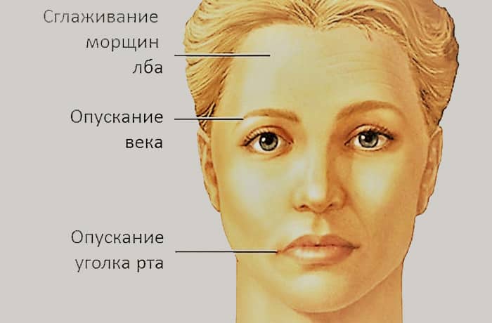 Происхождение и причины развития невропатии лицевого нерва • Клиника Crystal Touch