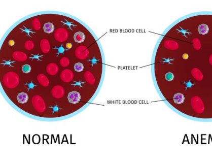 Що таке анемія крові Симптоми➢Причини➢Лікування