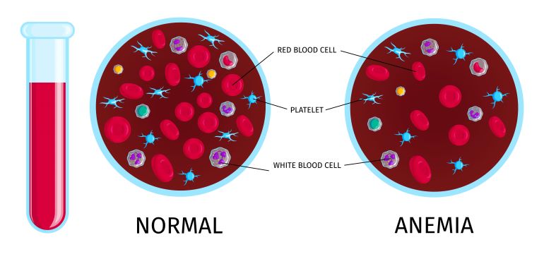 Що таке анемія крові Симптоми➢Причини➢Лікування